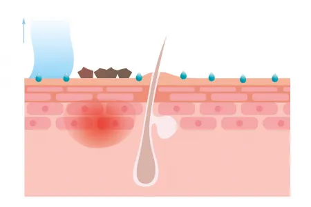 graphic representation of the cleansing effect of anti-acne cleansing products on dirt, perspiration and the effects of pollution